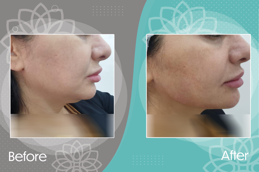 Eliminate your double chin