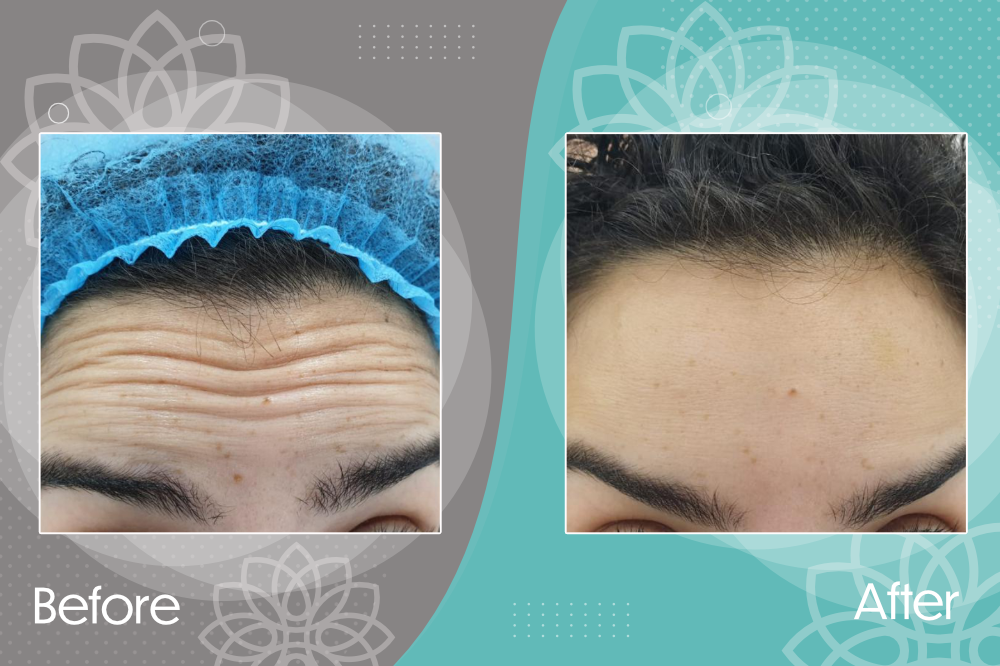 Eliminating wrinkles &amp; expression lines in forehead &amp; around eyes using botox