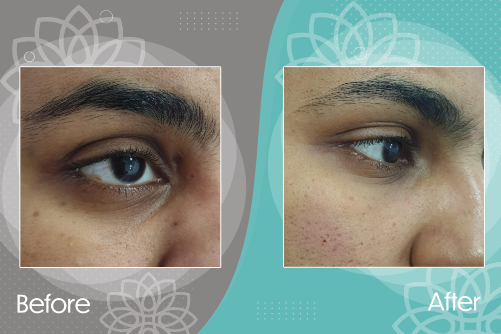 Filler injection to eliminate dark halos and tear trough