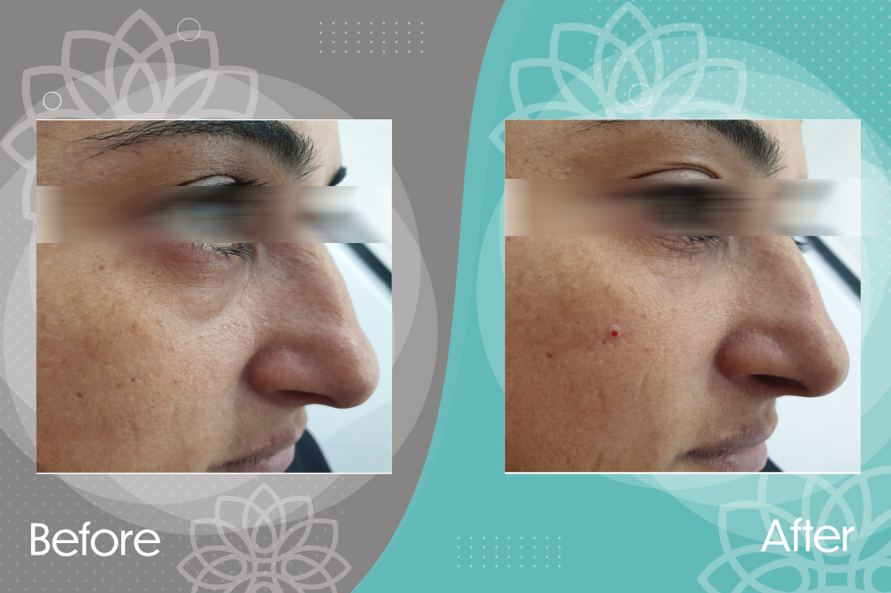 Eliminates Under Eye Puffiness 