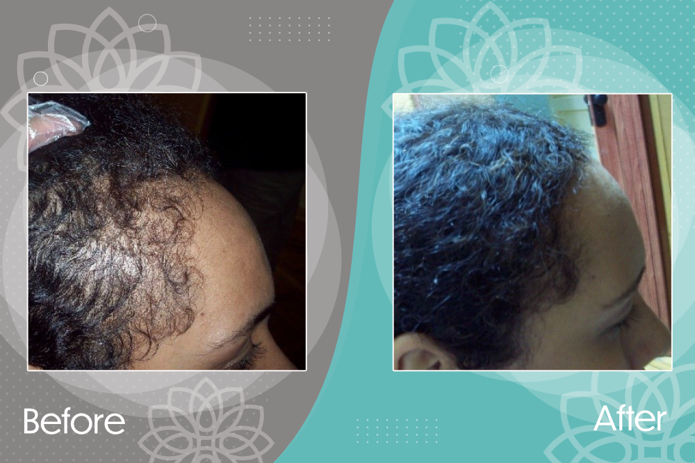 Excellent improvement in a case of severe hair fall.
