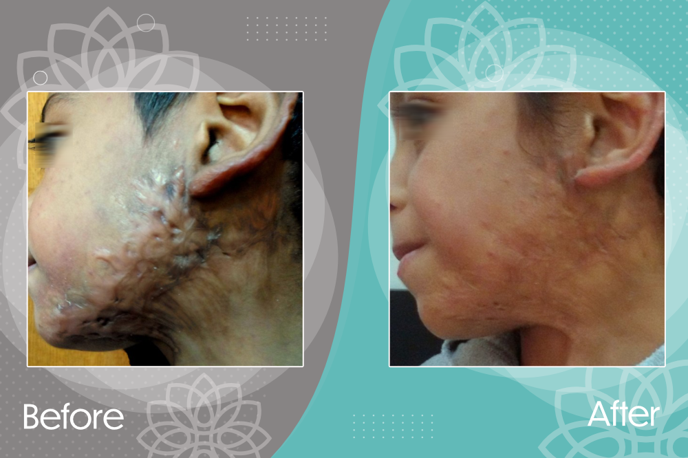 Hypertrophic scar treatment.