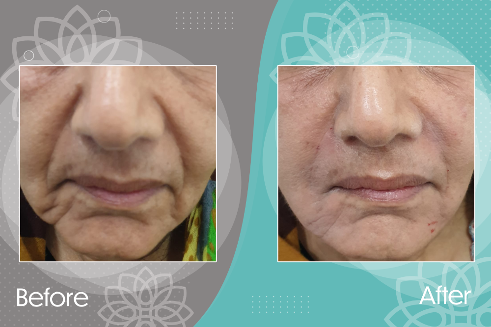 Nasolabial line improvement by filler injection.