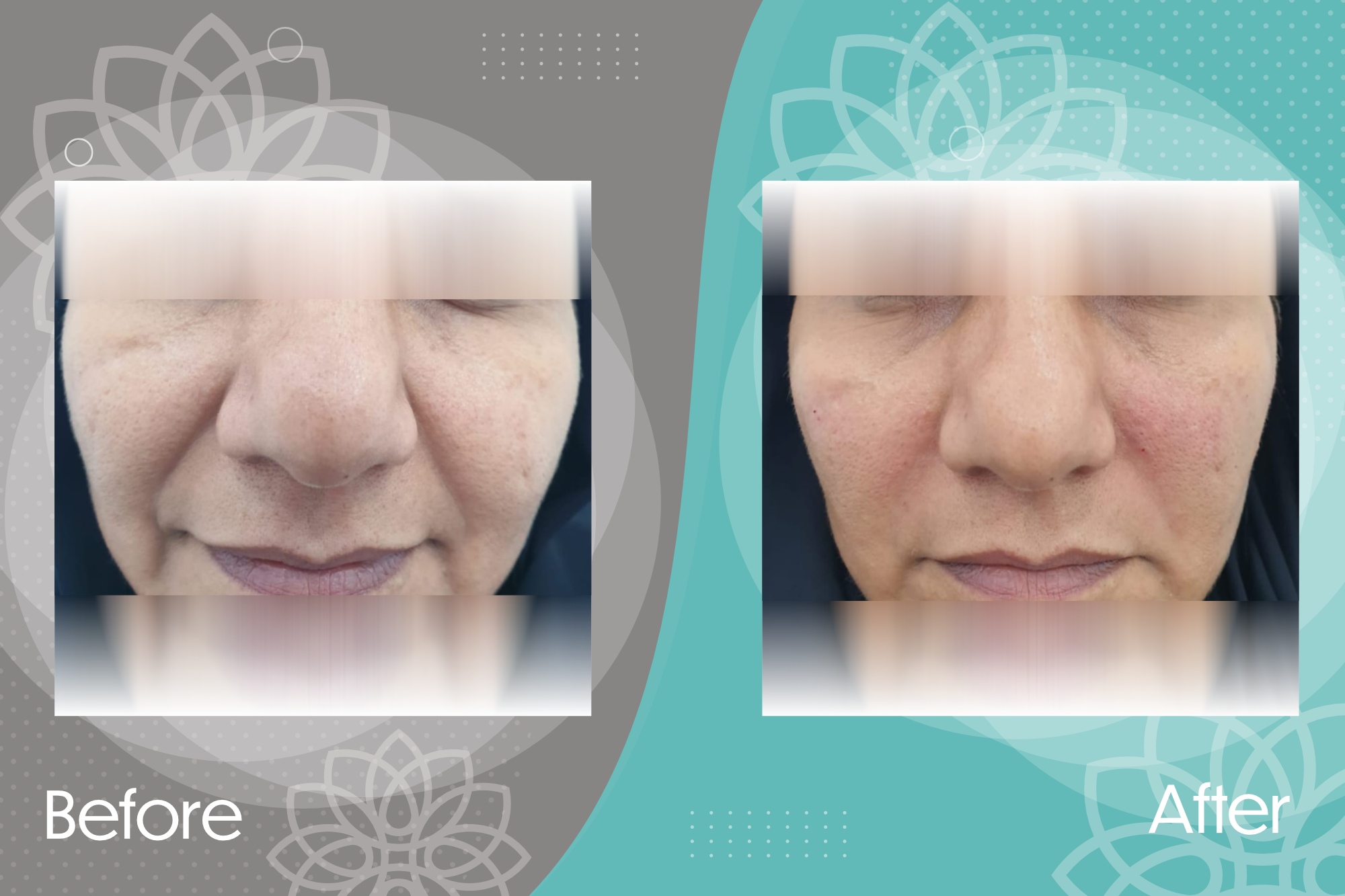 Improving glabellar contraction lines through botox injection