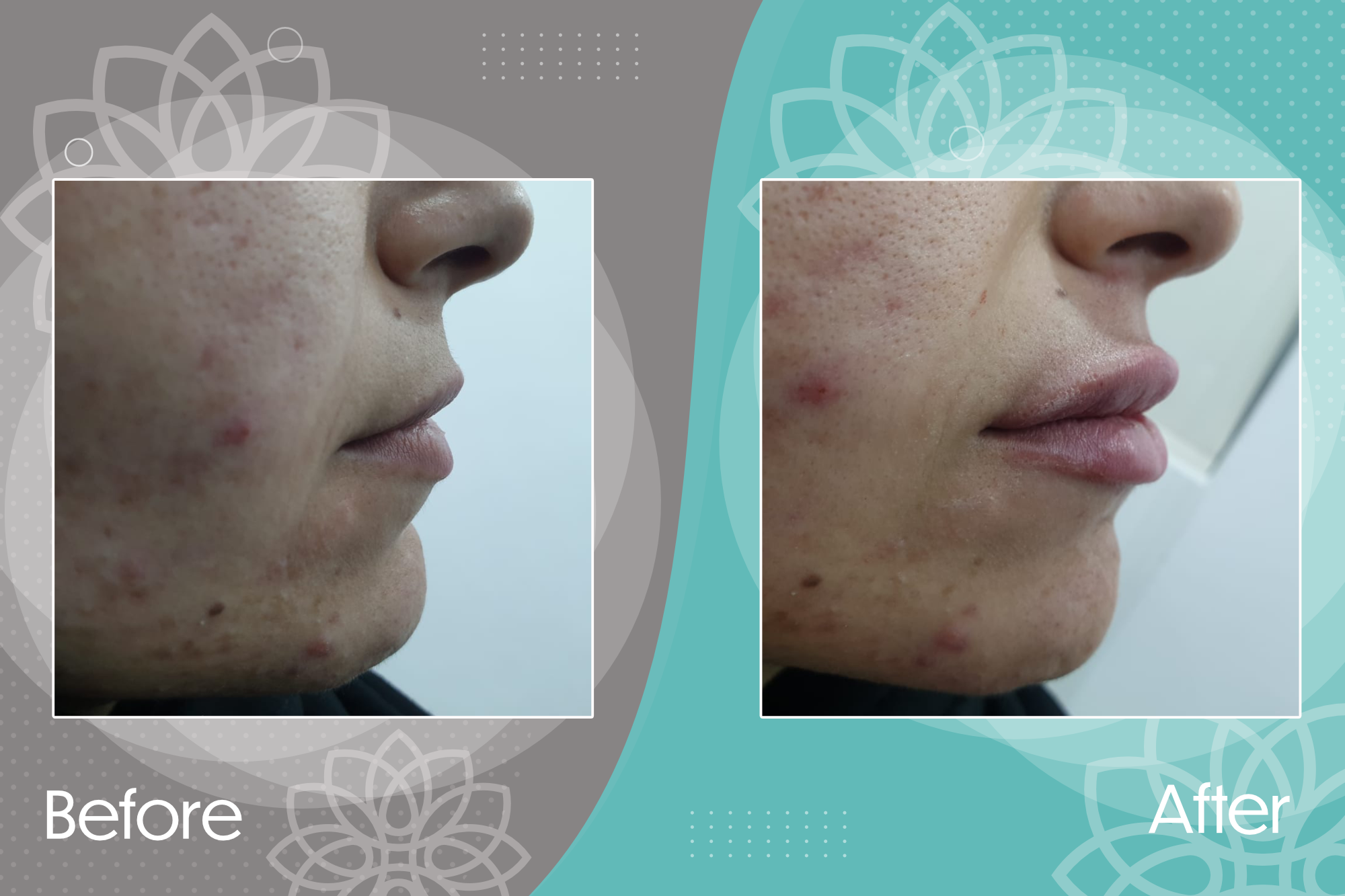 Filler injection to restore lip volume and decrease the distance between the nose and upper lip