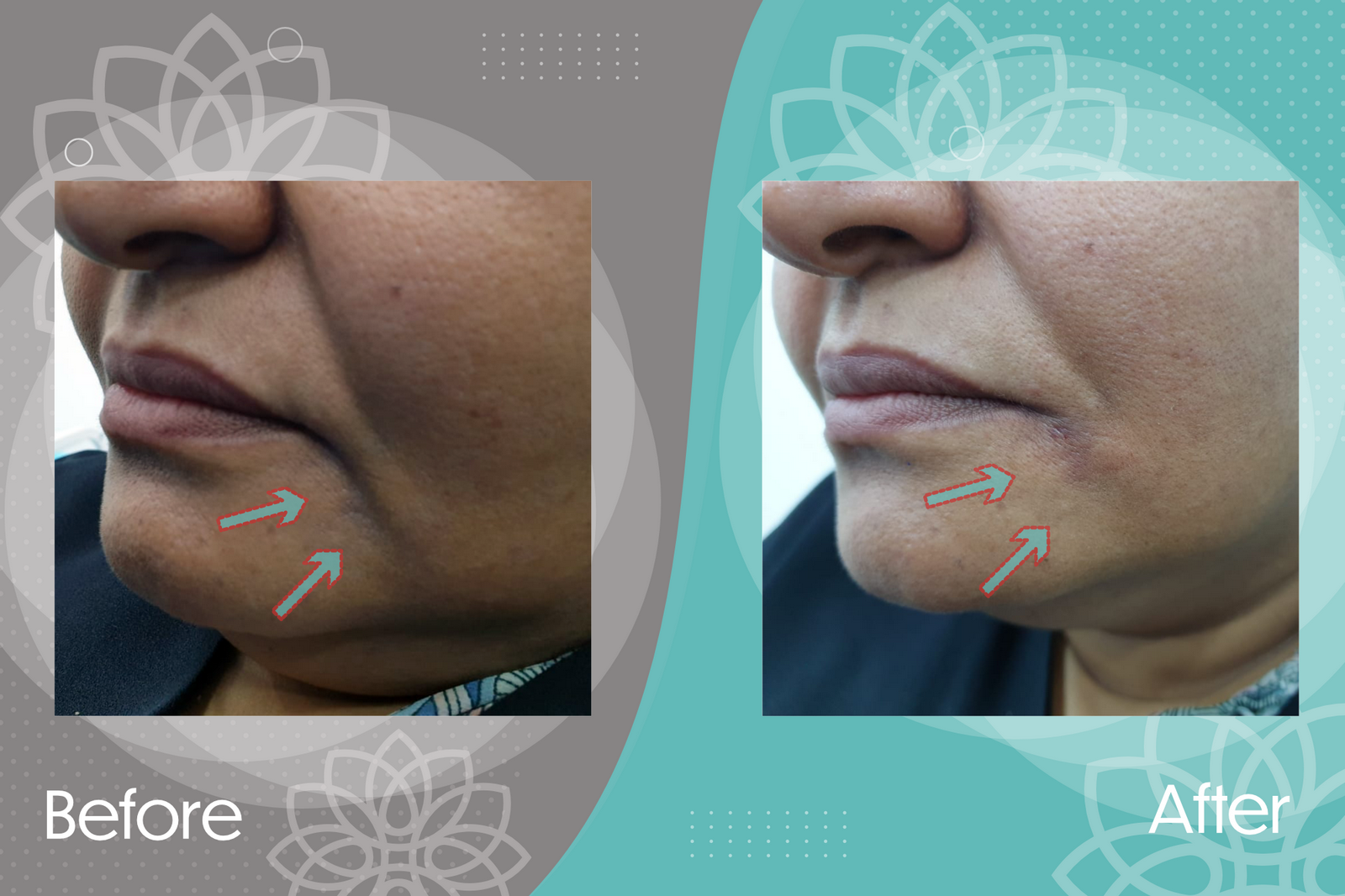 Marionette filler injections