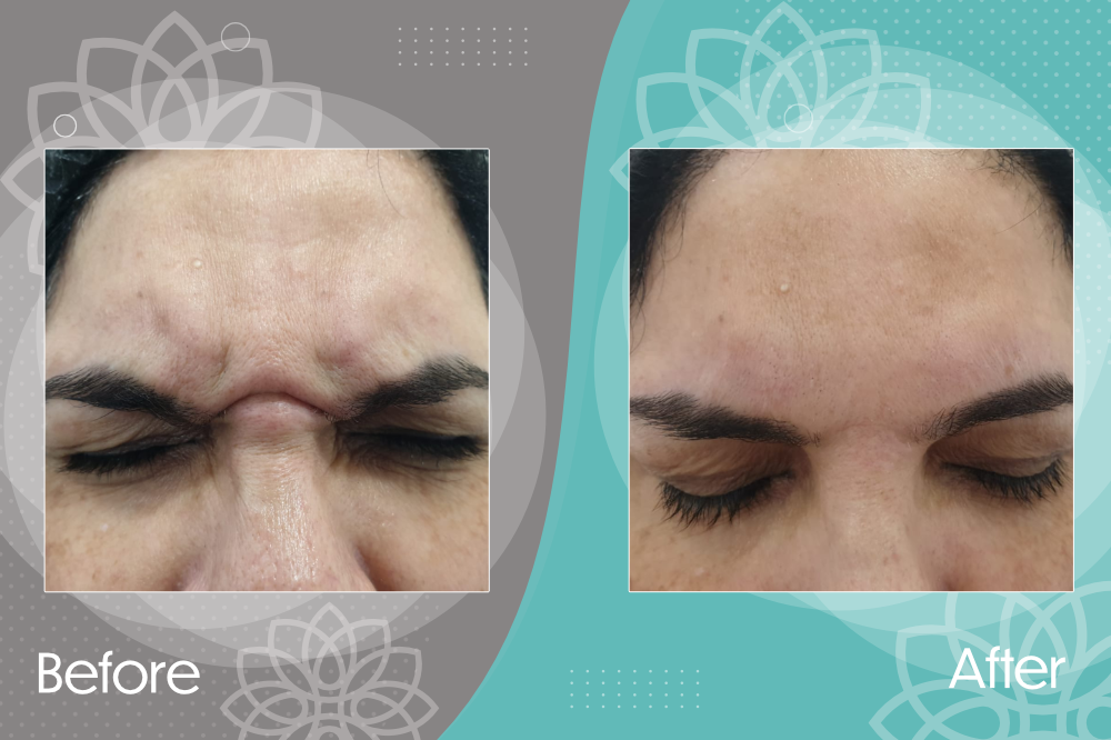 Botox injections to improve wrinkles