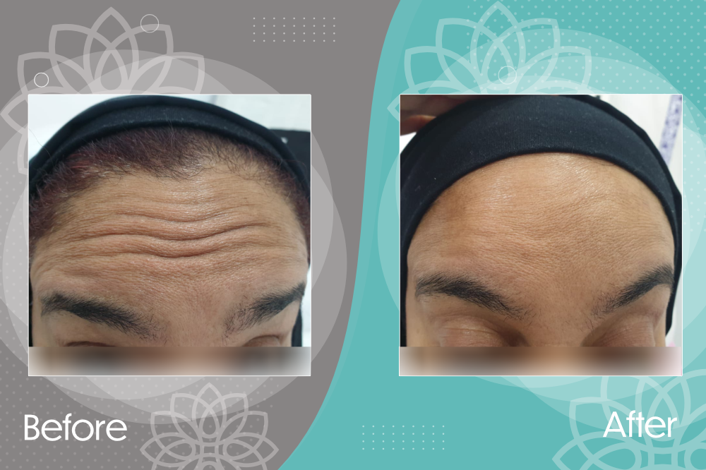 Hide forehead wrinkles with Botox injections