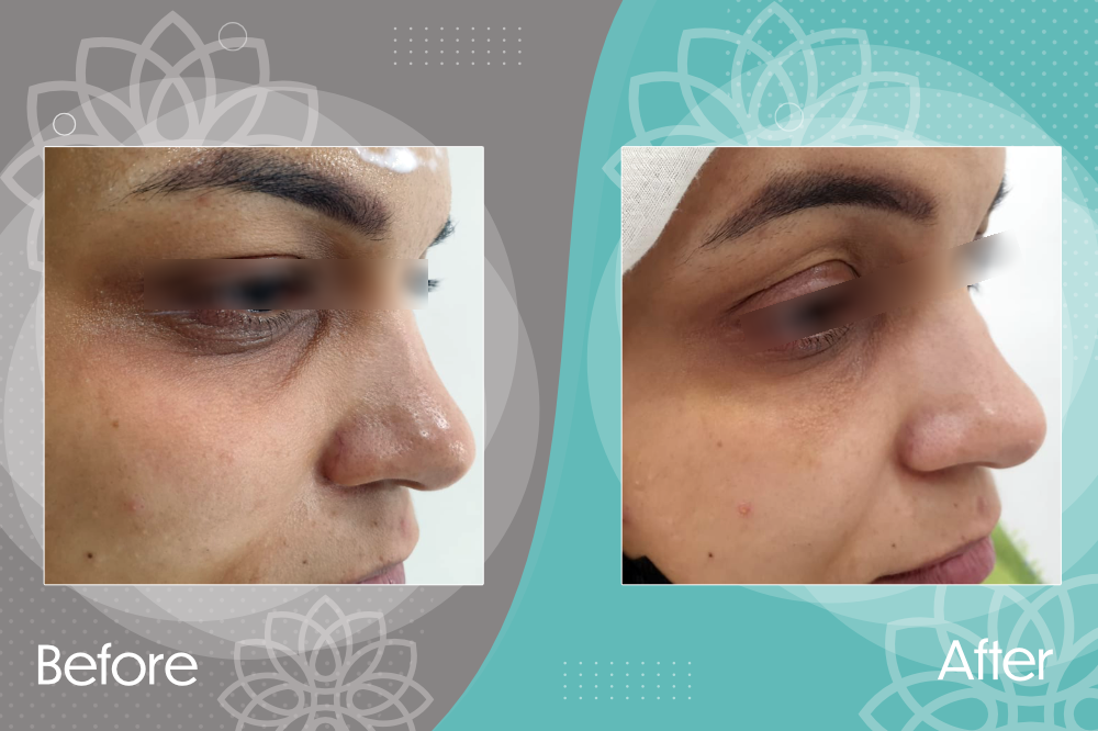 Under-eye filler injections